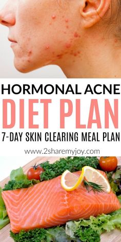 Are confused about how to eat when you suffer from acne? Does it seem like everything could cause acne? Are you wondering why your hormones are so out of balance? Try his gluten free, dairy free, sugar free meal plan and clear up your hormonal acne for good! 7-day hormonal acne diet plan: Best diet plan for clear skin. Find your acne triggers and learn how to eat when you suffer from hormonal acne. This is the best diet plan for acne! Sugar Free Meal Plan, Acne Triggers, Low Carb Diets