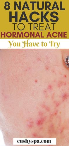 13 Best Tips to get rid of Pimples fast in 2025 Best Acne Scar Removal, There Is Always A Way, Home Remedies For Pimples, Pimples Remedies, Natural Acne Remedies, Natural Acne, Home Remedies For Acne, Treat Acne, Acne Scar Removal