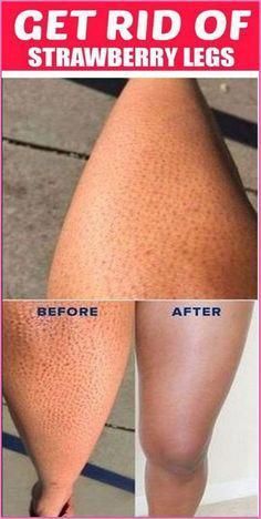 How to Get Rid of Strawberry Legs by Nina Bliznakovska | This newsletter was created with Smore, an online tool for creating beautiful newsletters for educators, businesses and more Strawberry Legs Remedy, Winter Lip Color, Body Maintenance, Strawberry Legs, Skin Care Ideas, Long Hair Tips, Brown Spots On Face, Lip Gloss Colors, Spots On Face