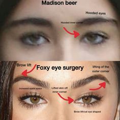 Madison Beer lip filler, face lift, eyebrow lift, canthoplasty (foxy eye surgery) eyebrow lift; Botox, lip flip, alarplasty (nose job) jaw/chin fillers and implants, cheek fillers, lying Foxy Eye Surgery, Madison Beer Lip Fillers, Madison Beer Nose, Eyelid Filler, Eye Lid Surgery, Jaw Filler, Eyes Surgery, Botox Eyes, Eye Bag Surgery