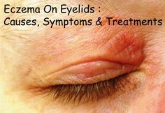 Eczema On Eyelids : Causes, Symptoms & Treatments | Disfreeskin Dry Eyelids Remedy, Wrinkly Eyelids, Dry Eyes Remedy Natural Treatments, Swollen Eyelids Remedy, Dry Eye Remedies, Itchy Eyelids, Dry Eyelids, Dry Eye, Dry Itchy Skin