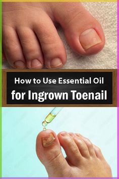 Ditch the remedies that don't work. Here's How to Use Essential Oil for Ingrown Toenails so you can get relief from the discomfort! Ingrown Toenail Relief, Diy Ingrown Toenail Remedy, How To Get Rid Of Ingrown Toenails, How To Treat Ingrown Toenail, Ingrown Toenail Remedy, Ingrown Toenail Remedies, Toenail Pain, Toenail Health, Nail Remedies