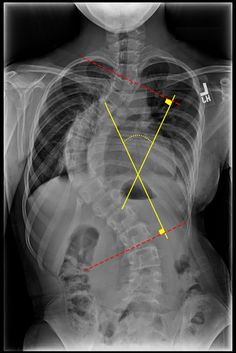 the chest is shown with an x - ray and arrows pointing up to each other