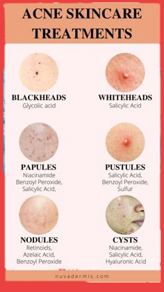 Haut Routine, Face Care Tips, Natural Acne, Good Skin Tips, How To Get Rid Of Pimples, Acne Solutions, Facial Skin Care Routine, Acne Remedies, Skin Care Remedies