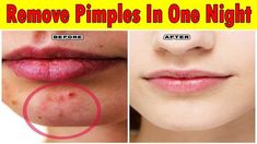 Pimples & Acne: Types, Causes, Home Remedies, and Tips Acne Types, Remove Pimples Overnight, Nose Pimples, To Remove Pimples, Ap Logo, Logo K