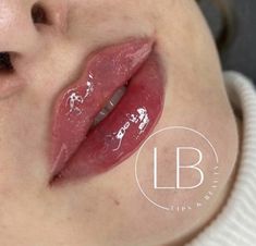 Butterfly Lip Filler, Defined Cupids Bow Lip Filler, Lips Fillers Shapes, Round Top Lip, M Shaped Lips, Bow Shaped Lips, Pouty Lip Filler, Russian Lips Filler