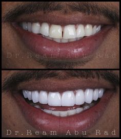 Fake White Teeth, Perfect Teeth Men, Veneers Teeth Styles, Teeth Fangs Natural, Veneer Teeth, Teeth Veneers, Cosmetic Dentistry Veneers, Teeth Aesthetic