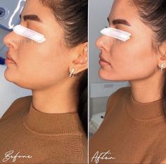 Filler Facial Contouring, Plastic Surgery Inspiration, Face Plastic Surgery Before After, Pixie Tip Lift Nose Filler, Jaw Line Fillers Before And After, Neck Botox Before And After, Facial Contouring Fillers, Chin Implant Before And After