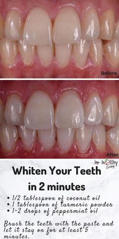 5 consejos para blanquear los dientes de forma natural Remedies For White Teeth, Dental Hacks, Coconut Oil Remedies, Face Wrinkles Remedies, Make Teeth Whiter, Baking Soda Teeth Whitening, Teeth Remedies, Lip Scrub Recipe, Teeth Whitening Homemade