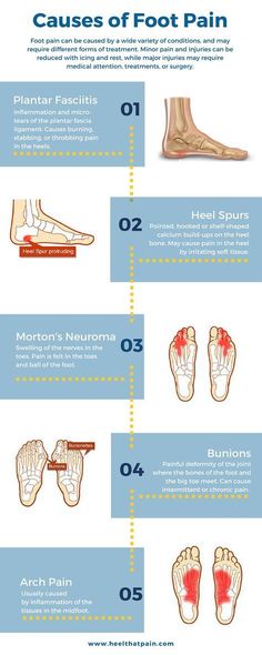 Foot pain chart: Do you know what's causing your foot pain? It may be one of a number of conditions: plantar fasciitis, heel spurs, bunions. Click to learn more about foot pain conditions. Foot Pain Chart, Pain Chart, Natural Headache, Morton's Neuroma, Natural Therapy, Heel Pain, Foot Pain, Knee Pain