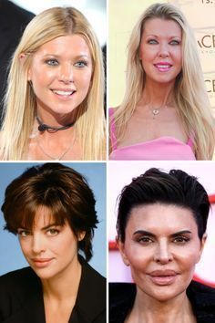 #plasticsurgery #plasticsurgerygonewrong #beforeafter #celebritiesbeforeafter #hollywoodstars #bignosesurgery #surgery #facesurgery #vlinesurgery #koreanplasticsurgery #kpopplasticsurgery #nosejob #jawreductionsurgery #eyesurgery #cheekfillers #rhinoplasty #facelift #plasticsurgeryfails #expensiveplasticsurgery Celebrity Surgery, Cheek Implants, Botox Lips