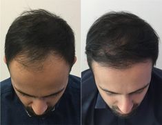 Follicular unit extraction (FUE) is a method of hair transplant that harvests viable follicular units (hair follicles) from a patient’s donor area, one at a time, to provide that patient with units that can then be used to create full hair restoration.  #Hairtransplant #Hairtransplantation #Hairrestoration #Fuehairtransplant #Coolsculpting #coolsculptinginToronto #torontocoolsculpting #CoolsculptingCanada Hair Transplant Procedure, Decent Wallpapers, Face Angles, Scalp Micropigmentation, Fue Hair Transplant, Facial Peel, Cool Sculpting, Hair Follicles, Full Hair