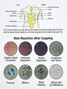 Cupping Therapy - Toronto Reflexology Nurse Ratchet, Qi Deficiency, Reflexology, Acupuncture, Health And Wellness, Toronto, Health