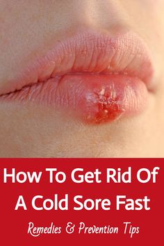 Save this pin to learn how to get rid of a cold sore with remedies and prevention tips from a lifelong cold sore sufferer! From effective treatments to practical prevention strategies, discover the best ways to manage and prevent cold sores. Cold Sore Prevention, Fever Blister, Cold Sores