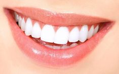 Natural Teeth Whitening Diy, Teeth Whitening Remedies, Teeth Whitening Diy, Beautiful Teeth, Laser Teeth Whitening, Pasta Dental, Perfect Teeth, Dental Veneers, Smile Teeth