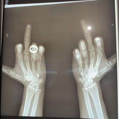 an x - ray image of two hands with one holding the other's thumb