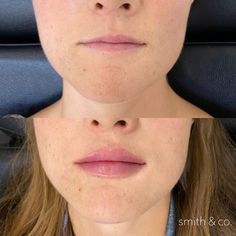 Kysse Lips Filler Before And After, Lip Filler Inspiration 1ml, Keyhole Lips, Lip Fillers Before And After 1ml, Facial Poses, Lip Filler Technique, Botox Lip Flip, Restylane Lips