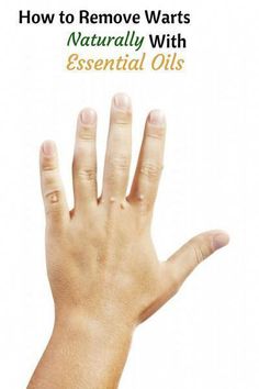 Remove warts naturally with essential oil can take time and persistence. Most warts are generally very stubborn and essential oil application needs What Causes Warts, Warts On Hands, Warts On Face, How To Remove Warts, Remove Warts, Losing 40 Pounds, Get Rid Of Warts, Sleep Remedies