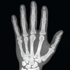 an x - ray image of a hand showing the bones