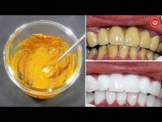 In this video, we will explain how to whiten teeth at home 100% natural only takes 3 minutes of preparing, thanks to which you can avoid spending money on co... How To Clean Yellow Teeth, How To Remove Yellow Teeth, Yellow Teeth Remedy, Plaque Removal At Home, Turmeric Teeth Whitening, Teeth Quotes, White Teeth Tips, Hubbard Squash, Baking Soda Teeth Whitening