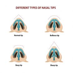 A bulbous nose job is a specialized type of rhinoplasty to re-size & re-shape a round, wide nasal tip. Learn more about what causes a nasal tip to be bulbous, how to treat it with rhinoplasty, and the surgery recovery process. Bulbous Nose Exercise, Bulbous Nose Aesthetic, Nose Job Bulbous Tip, Bulbous Tip Rhinoplasty, Wide Nose Rhinoplasty, Ethnic Nose Job, Bulbous Nose Rhinoplasty, Tip Rhinoplasty, Nose Job Recovery