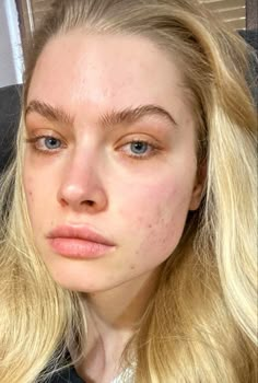 Textured Skin Aesthetic, Pretty People With Acne, Acne Positive, Face Imperfections, Acne Awareness, Acne Positivity, Skin Positivity, Lemon Face