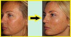 #facelift #estetik Face Lift, To Share, Tattoos