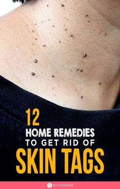 Skin Tags Removal, Skin Folds, Remove Skin Tags, Remedies For Skin, Home Remedies For Skin, Home Remedy For Cough, Skin Natural Remedies, Cold Sores Remedies