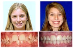 Before and after pics of patient treated for overbite...you can see the extreme change in her profile... Before And After Pics, Before And After Pictures, Change In, Nursing School, Braces, Nursing, Canning, Quick Saves