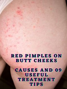 Are you concerned about red bumps on butt cheeks? The butt area is one of the most sensitive skin. The pimples usually appear as small red spots on butts. Pimple Redness Reducer, Body Pimples Remedies, How To Remove Red Spots On Face, How To Get Rid Of Red Bumps On Your Leg, How To Get Rid Of Pimples On Buttocks, How To Get Rid Of Buttocks Acne Quick, Clear Buttocks Skin Care, Dark Spots On Buttocks, Pimple On Back