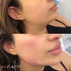 Facial Balancing Filler Before And After, Facial Balancing Filler, Chin Filler, Large Lips, Facial Contouring, Cosmetic Dermatology