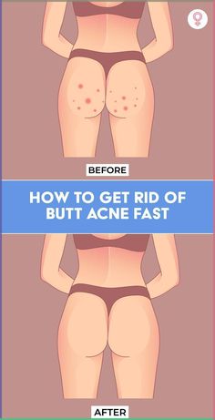 How To Get Rid Of Butt Acne Fast: The thought of having itchy, painful, and angry spots on your butt in your favorite swimsuit can be distressing. But if you feel all those dreams of wearing a swimsuit are crushed, think again. There are simple and quick remedies you can try at home to get rid of these pimples on buttocks. In this article, we delve deeper into the several home remedies you can try to say goodbye to butt acne. Buttocks Acne, Pimples On Buttocks, Back Acne Remedies, Cystic Pimple, Pimples Remedies, Pimples On Face, Natural Acne Remedies, Resep Diet, How To Get Rid Of Pimples