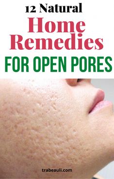 Remedies For Pores On Face, Reduce Pores On Face Diy, Reduce Open Pores On Face, Pore Tightening Products, How To Reduce Open Pores On Face, Open Pores Remedy Natural Treatments, Home Remedy For Open Pores, Open Pores On Face, Huge Pores