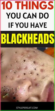 You can easily get rid of these blackheads by usin Blackhead Remedies, Blackheads On Nose, Rid Of Blackheads, Blackheads Removal, How To Get Rid Of Pimples, Get Rid Of Blackheads, Homecoming Makeup Browneyes, Hoco Makeup, Makeup Looks For Brown Eyes