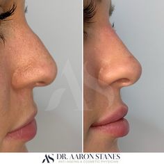 Nose Job Inspiration Side Profile, Natural Side Profile, Natural Nose Job Before After, Side Profile Before And After, Lip Fillers Side Profile, Noses Side Profile, Lip Filler Side Profile, Natural Nose