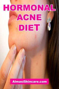 Hormonal Acne Diet - Almasi Skincare Peppermint Tea Drinks, Skin Clinic, Hormonal Changes, How To Get Rid Of Acne