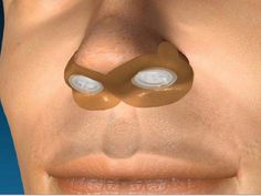 An alternative form of C.P.A.P. is gaining popularity for sleep apnea patients: a patch that fits over the nostrils. Remedies For Insomnia, Home Remedies For Snoring, Sleep Insomnia, Natural Sleep Remedies