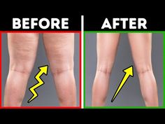 the before and after pictures show how to get rid from varicosis on legs