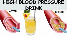 Drinks That Regulate High Blood Pressure & Clean Arteries - YouTube Clean Arteries, Heart Arteries, High Blood Pressure Recipes, High Blood Pressure Medication, Lower Cholesterol Naturally, Lower Blood Pressure Naturally, Cardiac Diet, Clogged Arteries, Health Heal