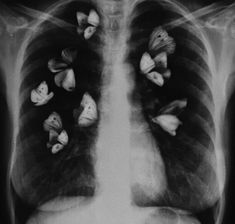 an x - ray shows the chest and lungs with small butterflies on it's chest