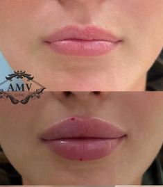 Lip Injections On Small Lips, Lip Filler Contour, Russian Lip Filler Aesthetic, Hollywood Lips Filler, Ariana Grande Lip Fillers, Lip Filler Bottom Lip Bigger, M Shape Lip Filler, Lip Filler No Cupids Bow, Lip Filler Examples