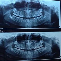 Dental Procedures for Impacted Wisdom Teeth Wisdom Teeth Quotes, Impacted Wisdom Teeth, Tooth Crown, Tooth Tattoo, Sensitive Teeth Remedy, Teeth Whitening Pen, Dental Bridge