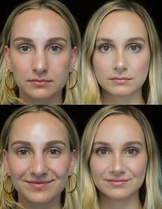 Jaw Reduction Surgery, Plastic Surgery Fail, Plastic Surgery Gone Wrong, Face Surgery