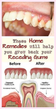 7 Natural Ways To Treat Receding Gums.
#dentalhealth, #dentalhealthcare Fix Teeth, Hollywood Smile, Gum Inflammation, Swollen Gum, Dental Health Care, Poor Nutrition, Nice Teeth