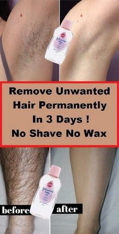 Chin Hair Removal, Electrolysis Hair Removal, Hair Remove, Hair Removal Diy