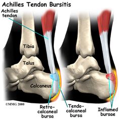 Physiotherapy in Regina, Physiotherapy for Achilles Tendon Problems Achilles Bursitis, Heel Bursitis, Ankle Rehab, Haglunds Deformity, Achilles Tendinopathy