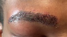 African-American Male Eyebrow Hair Transplant Close-up 1 Day Out Eyebrow Transplant Before After, Black Person, Before And After Pictures, Behind Ear Tattoo