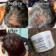 Hair Regrowth Treatments, Peppermint Oil, Virgin Coconut Oil, Hair Regrowth, Puffy Eyes, Burn Belly Fat, Tree Oil, Tea Tree Oil, Jojoba Oil