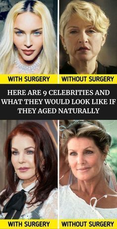 Extreme Plastic Surgery, Plastic Surgery Fail, Plastic Surgery Gone Wrong, Elvis Impersonator, Old Celebrities, Celebrities Then And Now, Celebrities Before And After, Hairstyle Women