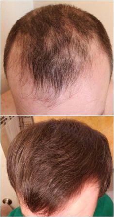 Hair Restoration Laboratories clinically tested shampoos, conditioner and serums help stop hair loss and regrow stronger, healthier, and thicker hair. Hair Restoration Remedies, Shampoo For Loss Of Hair, Hair Growth Hairstyles, Hair Regrowth Remedies, Hair Regrowth Women, Natural Hair Regrowth, Stop Hair Breakage